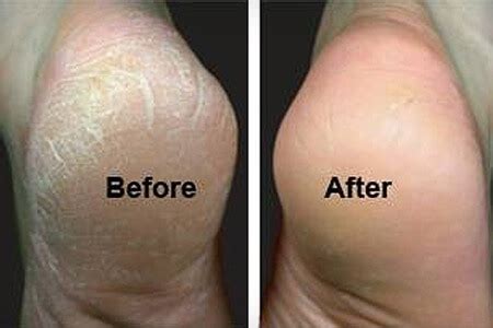Transmuting magical foot callus removing sandals